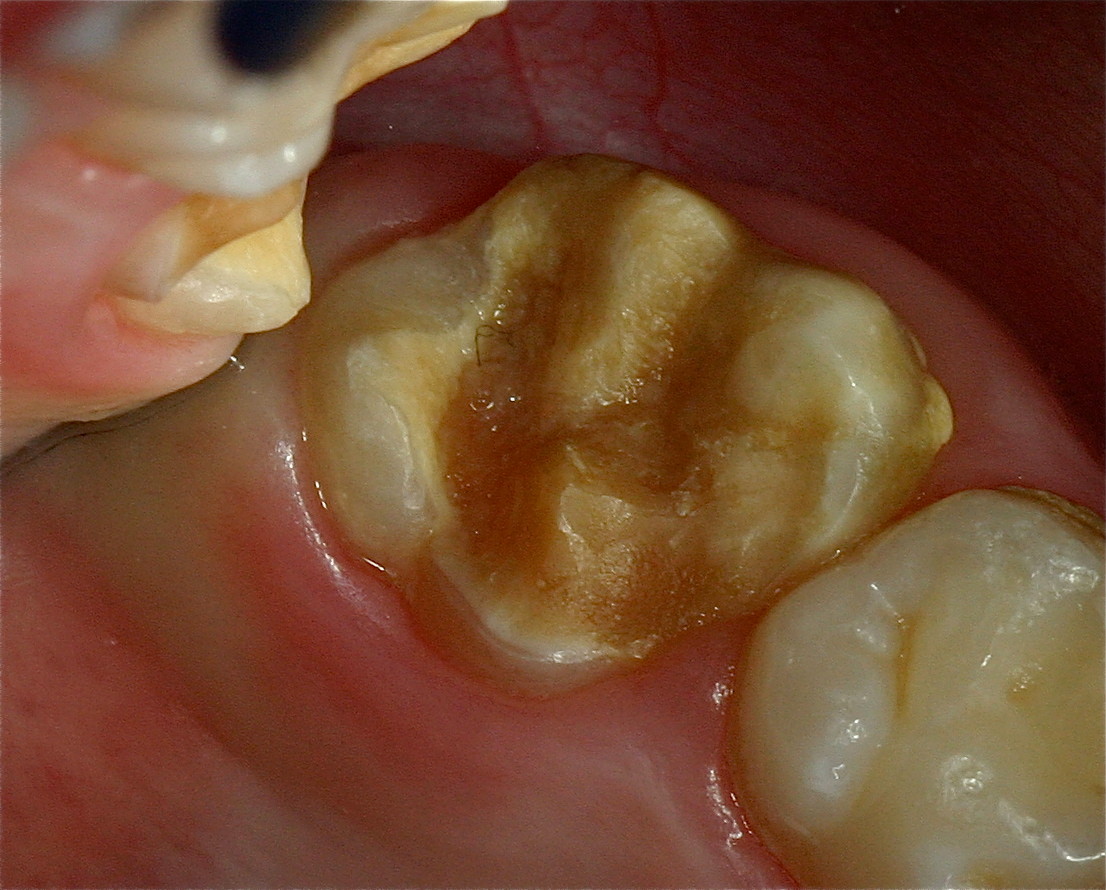 Zähne mit MIH (Molaren-Inzisiven-Hypomineralisation) (Bild 3)
