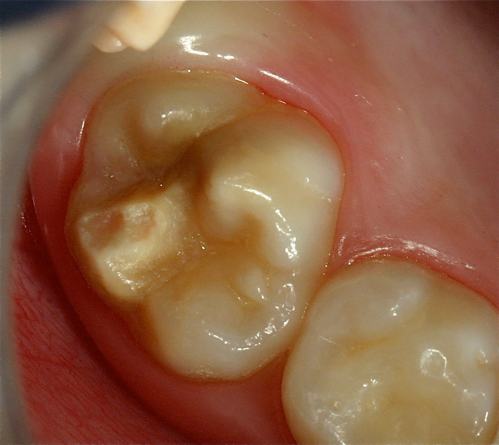Zähne mit MIH (Molaren-Inzisiven-Hypomineralisation) (Bild 2)