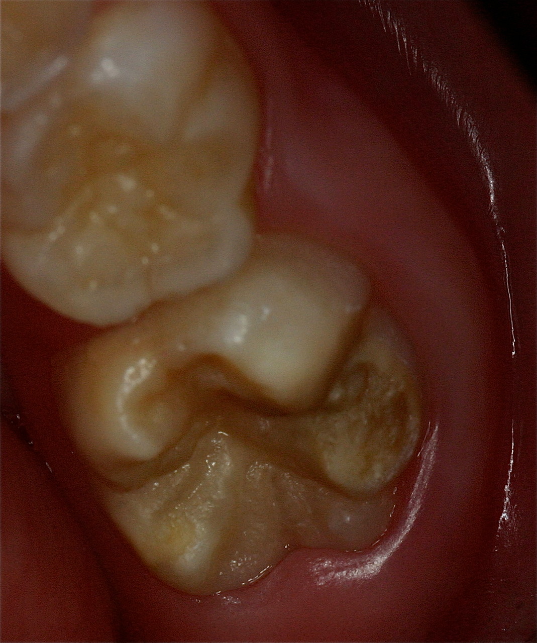 Zähne mit MIH (Molaren-Inzisiven-Hypomineralisation) (Bild 4)